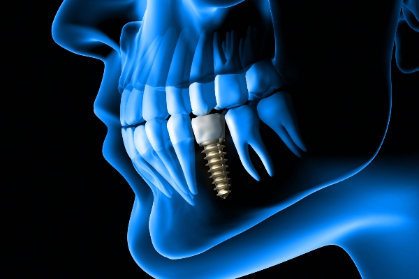 Is Bone Grafting Necessary For Dental Implants?