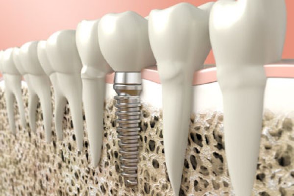 Bone Graft For Dental Implants Plano, TX