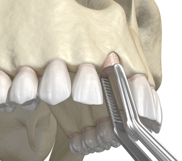 Plano Bone Grafting for Dental Implants