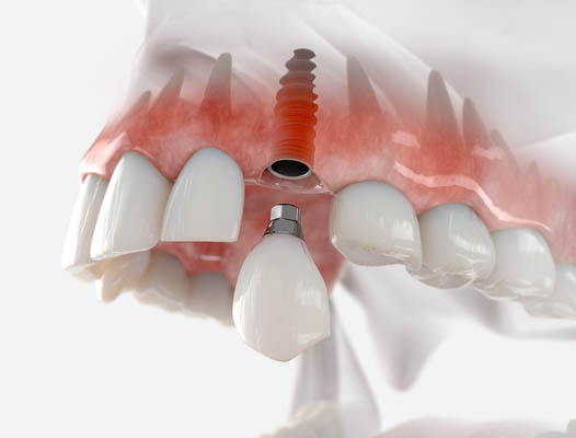 A Permanent Solution: Understanding Dental Implants