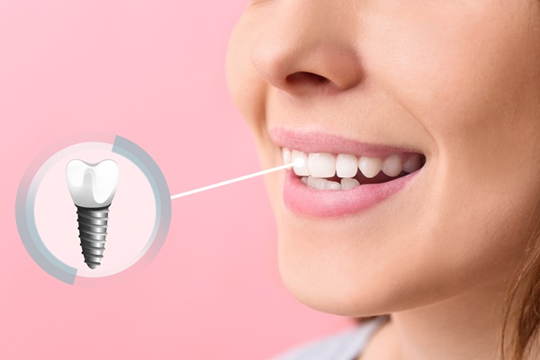 FAQs About Dental Implants