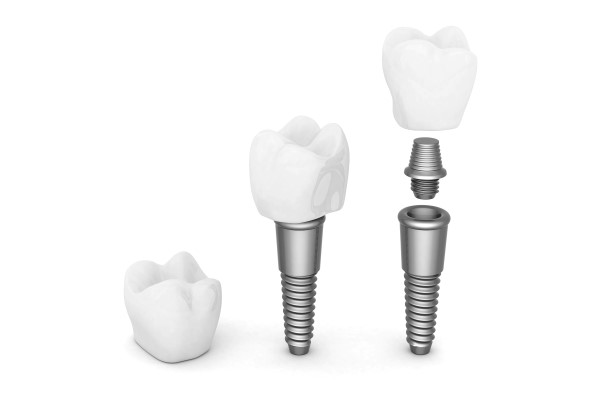 Dental Implants Plano, TX
