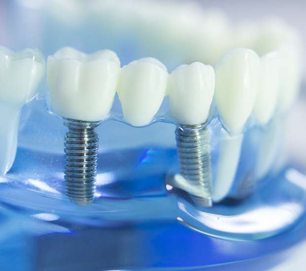 Plano Dental Implants