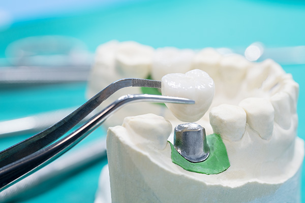 General Dentistry Solutions Using Dental Crowns from Texas Implant & Dental Specialists in Plano, TX