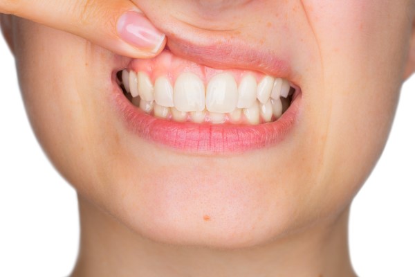 Benefits Of Gum Rejuvenation Treatment