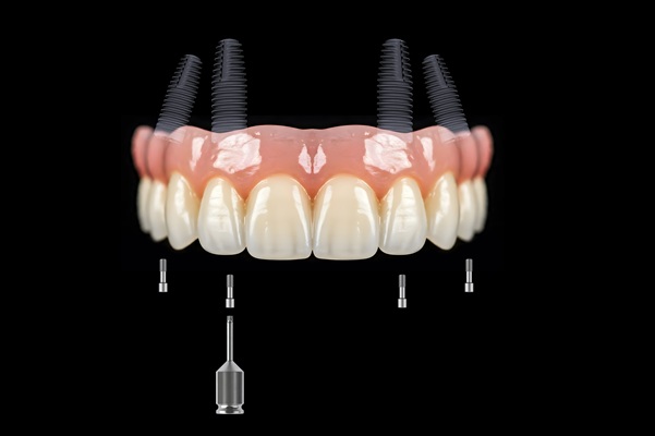 How To Care For Implant Anchored Dentures