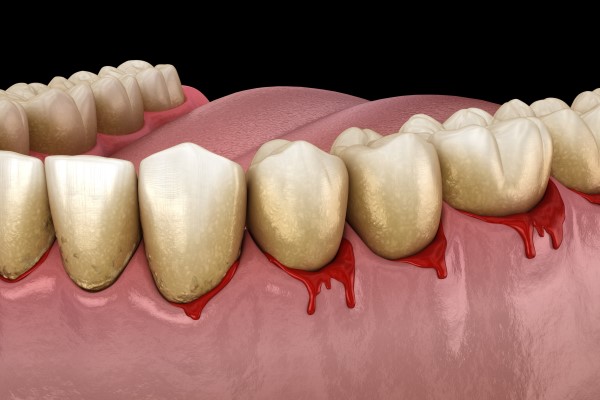 Ask A Periodontist: Are Bleeding Gums A Cause For Concern?