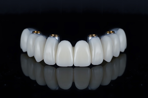The Process Of All On   Dental Implants By A Periodontist